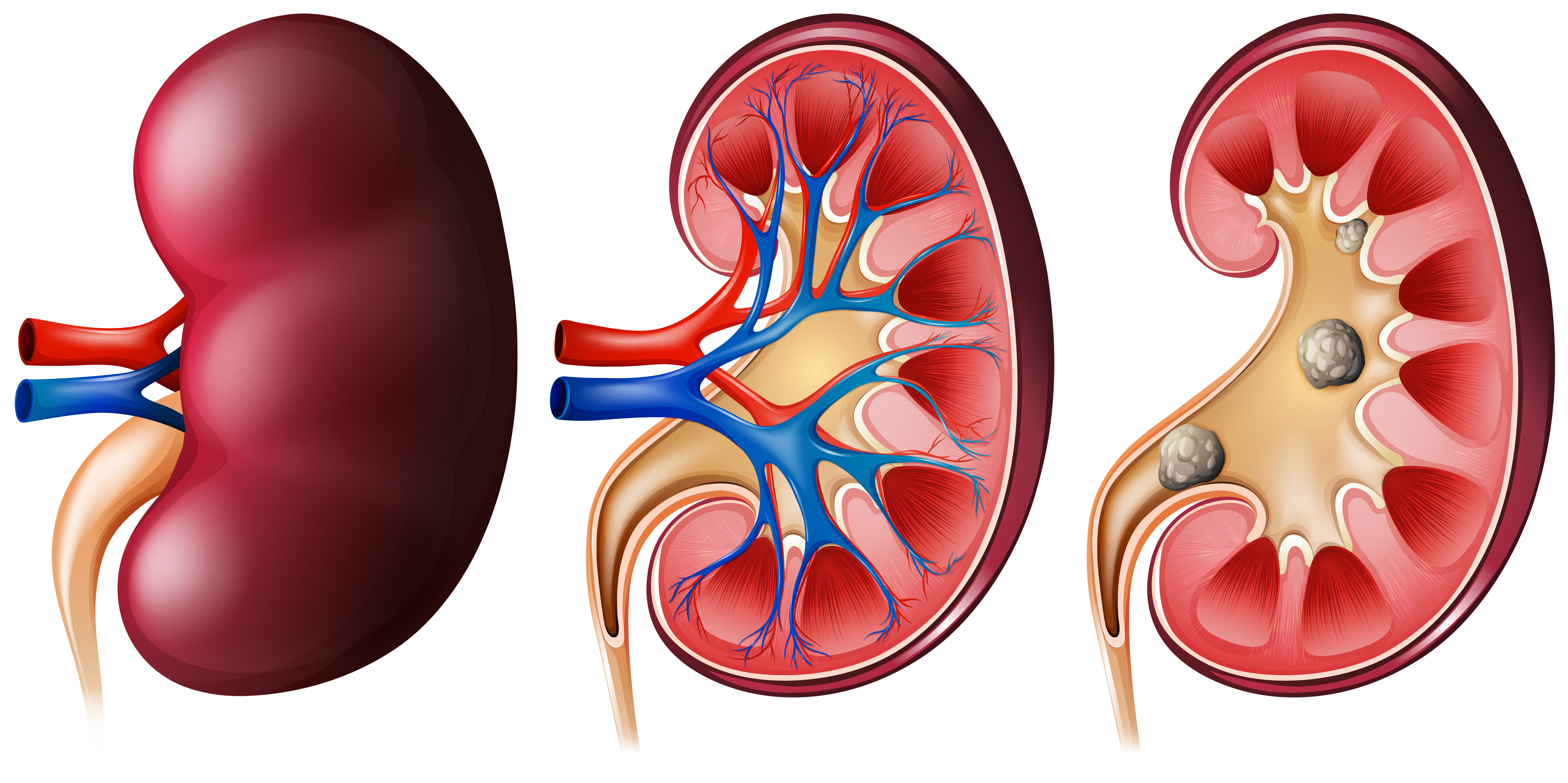 latest-treatment-options-for-kidney-cancer